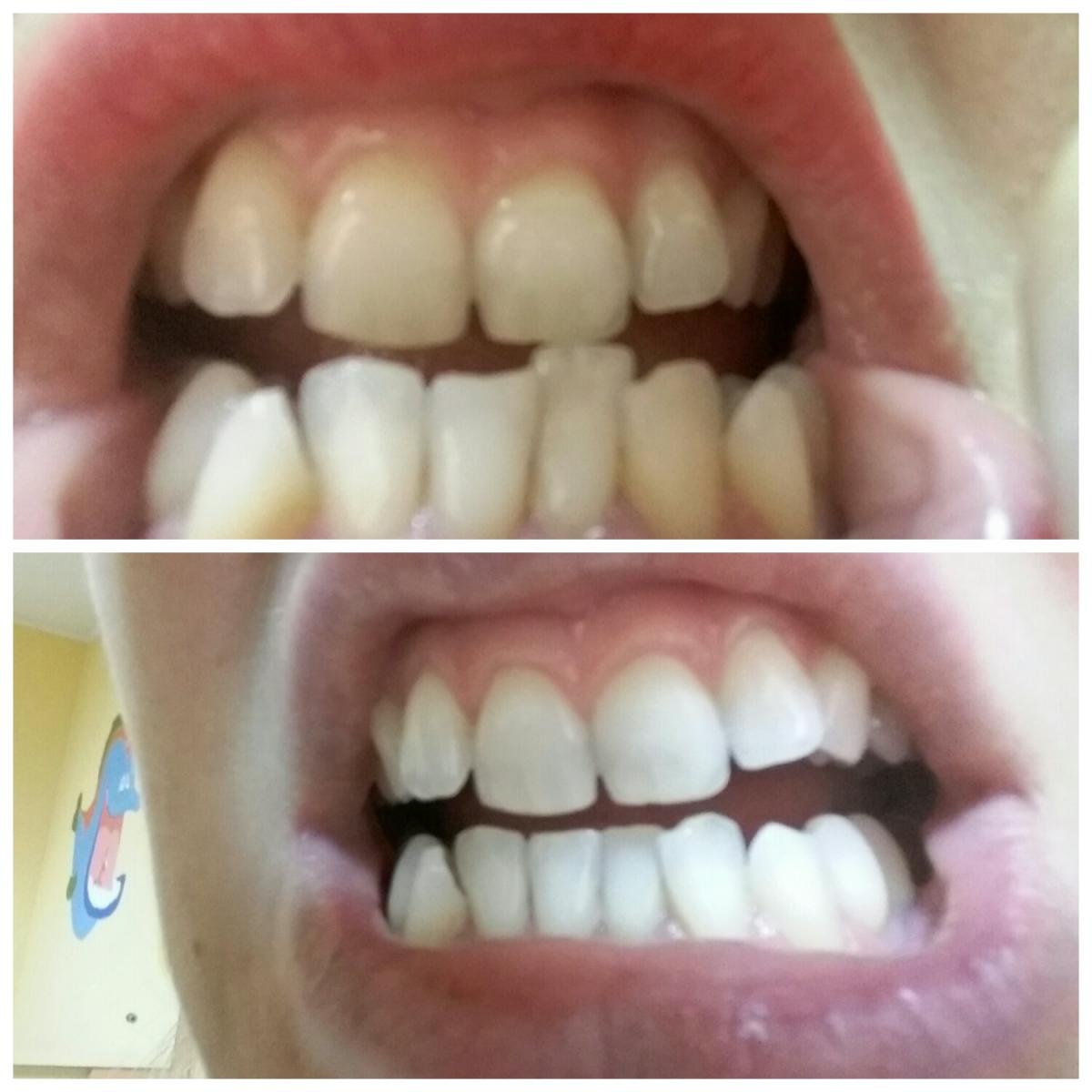 Estetică dentară - Tratament de albire dentară