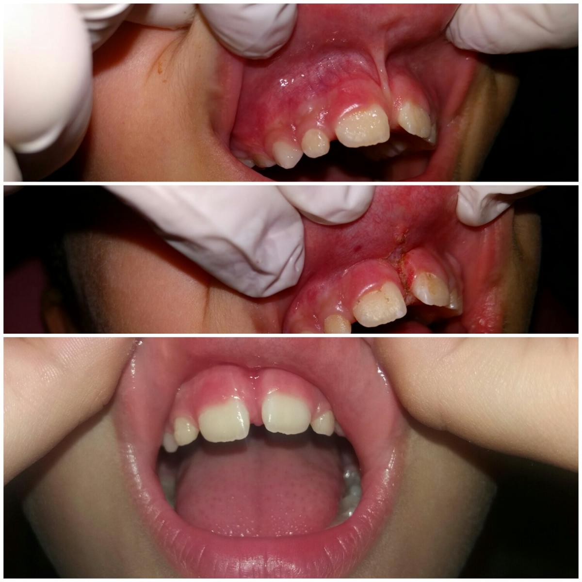 Laser dentar - Frenectomie cu laser (inainte, după intervenţie şi după vindecare)