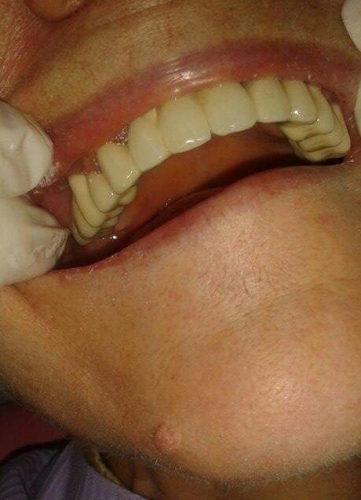 Coroane ceramice total fizionomice