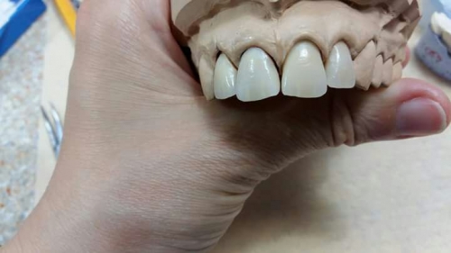 Coroane de ceramică pe suport de zirconiu